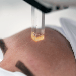 Spider Veins & Telangiectasia Treatment
