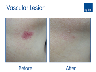Lumina Laser Treatment Before and After Result